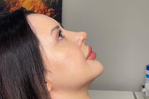Is Rhinoplasty Safe for Older Adults?