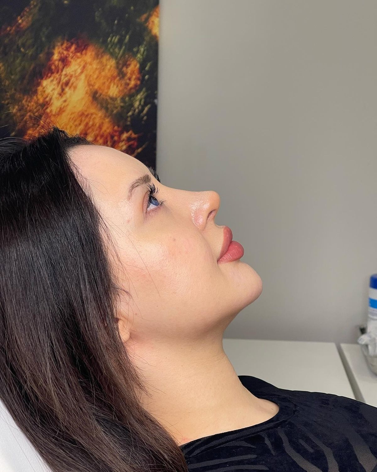 Is Rhinoplasty Safe for Older Adults?
